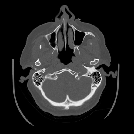 Eagle syndrome | Image | Radiopaedia.org