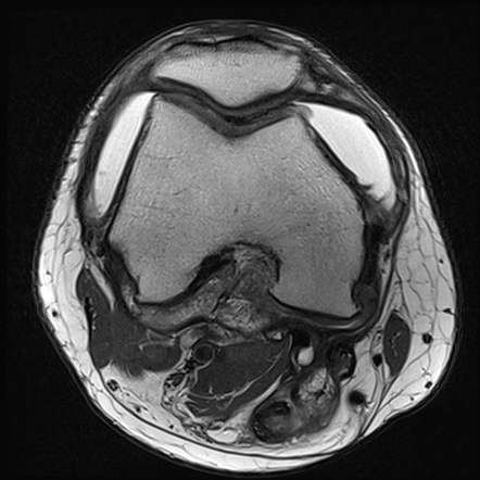 Pigmented villonodular synovitis | Image | Radiopaedia.org