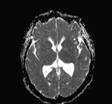 Bilateral stenosis of the foramina of Monro | Image | Radiopaedia.org