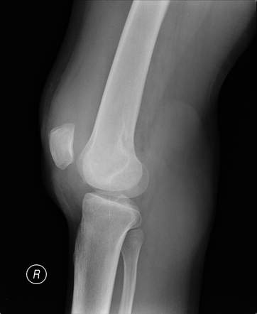 Pigmented villonodular synovitis | Image | Radiopaedia.org