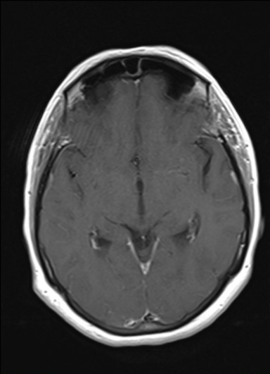 Bilateral Stenosis Of The Foramina Of Monro Image 0417