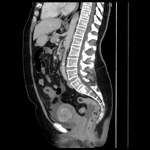 Infectious enteritis | Image | Radiopaedia.org