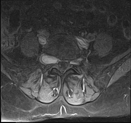 Spinal schwannoma | Radiology Case | Radiopaedia.org