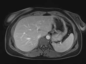 Focal nodular hyperplasia | Image | Radiopaedia.org