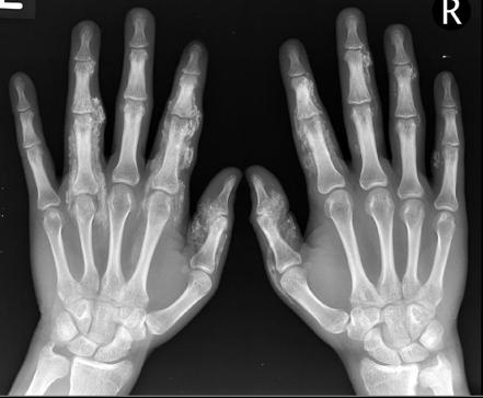 Dermatomyositis | Radiology Reference Article | Radiopaedia.org