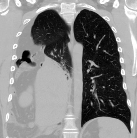 Diaphragmatic rupture | Radiology Reference Article | Radiopaedia.org