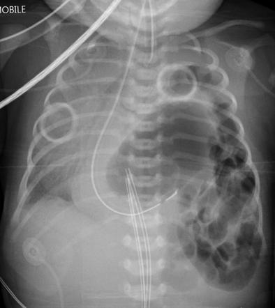 Congenital diaphragmatic hernia | Radiology Case | Radiopaedia.org