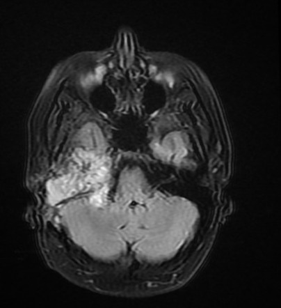 Jugulotympanic paraganglioma | Radiology Case | Radiopaedia.org