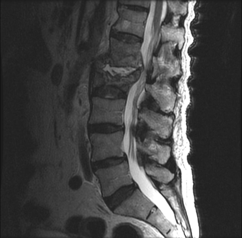 Спондилодисцит. Остеомиелит позвоночника. Остеомиелит поясничного отдела позвоночника. Остеомиелит позвоночника l3.