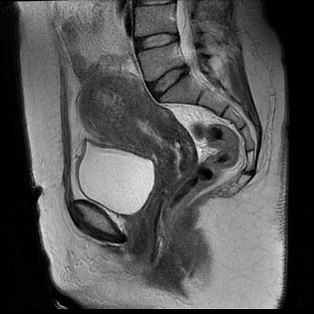 Adenomyosis of the uterus | Radiology Case | Radiopaedia.org