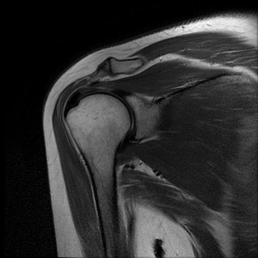 Calcific Tendinitis Supraspinatus Tendon Image Radiopaedia Org