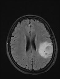 Low grade glioma | Image | Radiopaedia.org