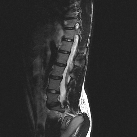 Spinal dysraphism with neuropathic bladder and charcot joint ...