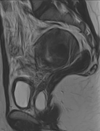 Gartner duct cyst | Image | Radiopaedia.org