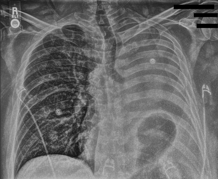 Lung cancer causing complete atelectasis | Radiology Case | Radiopaedia.org