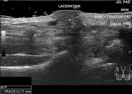 Flexor carpi radialis tendon laceration | Radiology Case | Radiopaedia.org