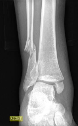 Weber Classification Of Ankle Fractures | Radiology Reference Article ...