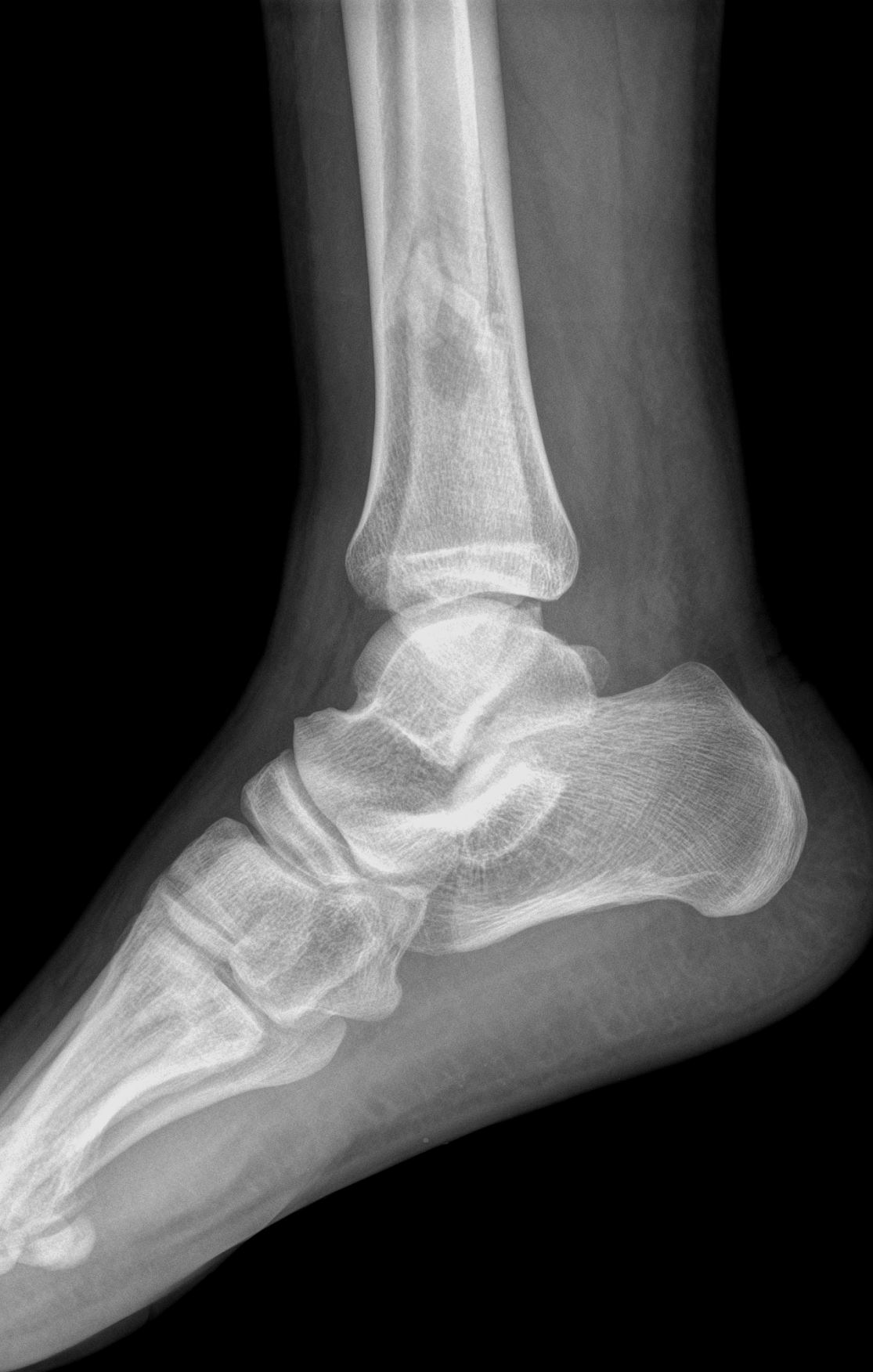 Ankle fracture - Weber C | Image | Radiopaedia.org