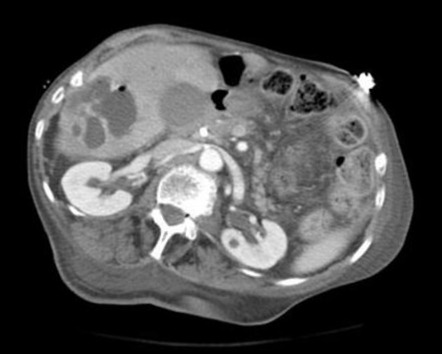 liver abscess case study slideshare