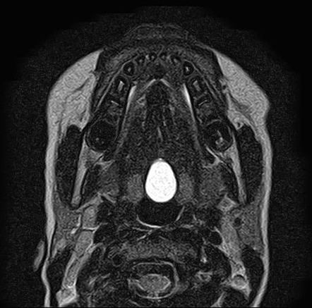 Lingual Thyroglossal Duct Cyst | Image | Radiopaedia.org