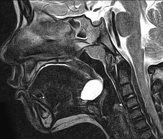 Lingual Thyroglossal Duct Cyst | Image | Radiopaedia.org