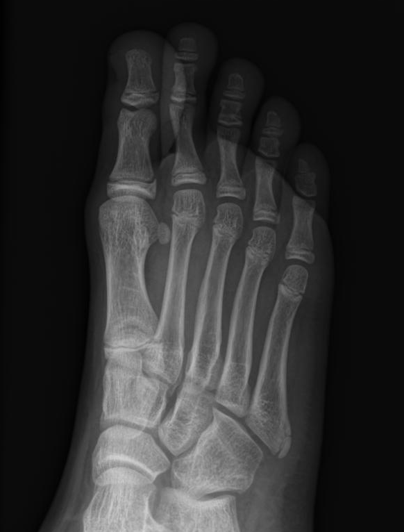 Normal apophysis of the proximal 5th metatarsal | Image | Radiopaedia.org