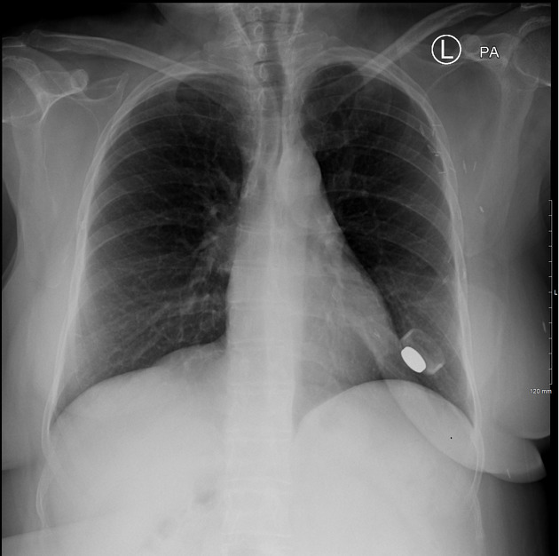 Expandable breast implant Radiology Case Radiopaedia