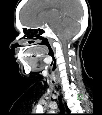 Ectopic thyroid | Image | Radiopaedia.org