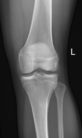 Osteochondral knee fracture due to pivot-shift injury | Image ...