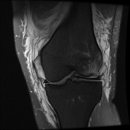 Osteochondral knee fracture due to pivot-shift injury | Radiology Case ...