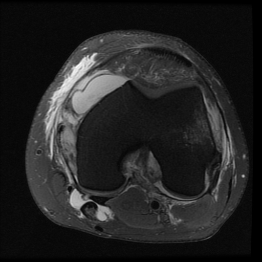 Osteochondral knee fracture due to pivot-shift injury | Image ...