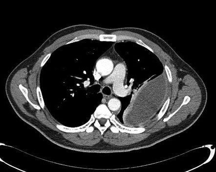 Empyema | Radiology Case | Radiopaedia.org