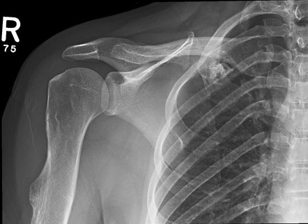 Osteochondroma | Radiology Case | Radiopaedia.org