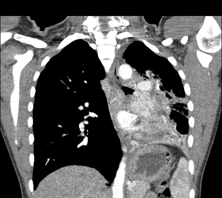 Bronchial carcinoid tumor | Image | Radiopaedia.org