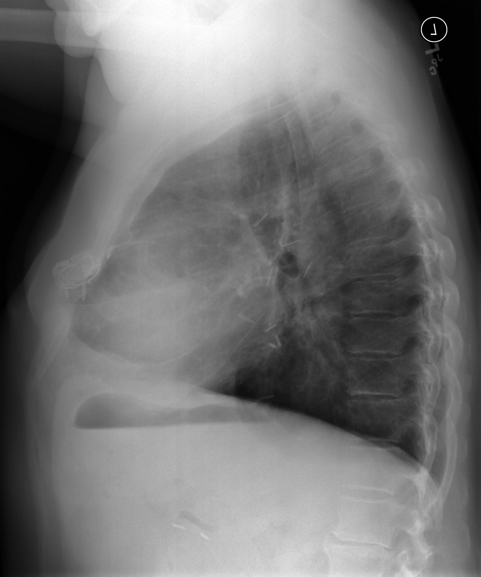 Obliterative bronchiolitis in a lung transplant | Image | Radiopaedia.org