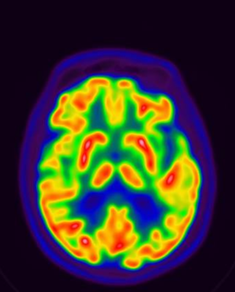 Normal Brain Amyvid And Fdg Pet Ct Scans For Dementia 