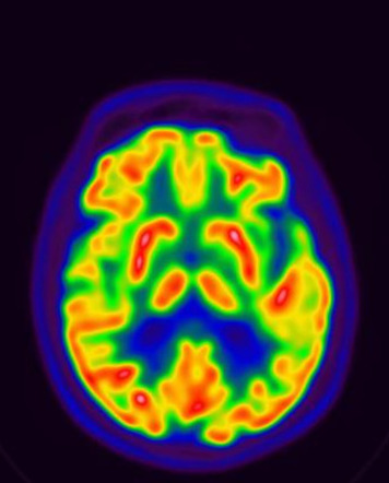 Normal Brain Amyvid and FDG PET/CT scans for dementia | Image ...