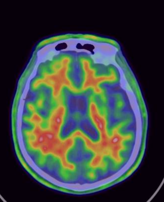 Normal Brain Amyvid And Fdg Pet Ct Scans For Dementia 