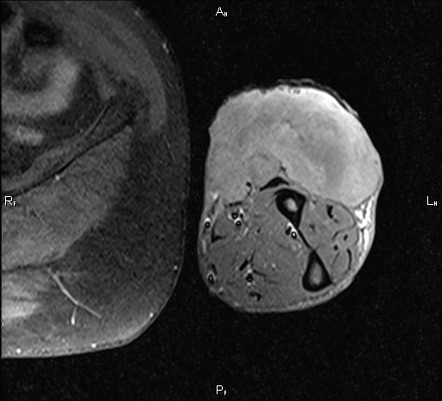 Metastatic soft tissue angiosarcoma | Radiology Case | Radiopaedia.org