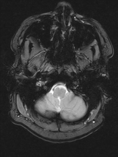 Neurosarcoidoisis - meningeal and pituitary infindibulum involvement ...