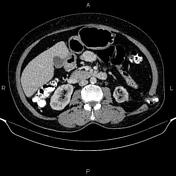 Inferior lumbar triangle, Radiology Reference Article