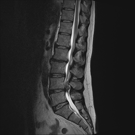 Dorsal epidural disc migration | Radiology Case | Radiopaedia.org