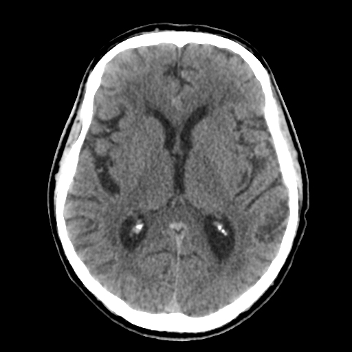 Subacute posterior inferior cerebellar artery infarct | Image ...