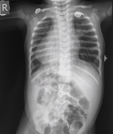 Situs inversus | Radiology Case | Radiopaedia.org