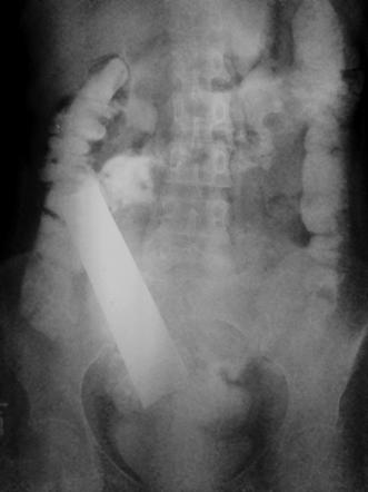 Medical devices in the abdomen and pelvis | Radiology Reference Article ...