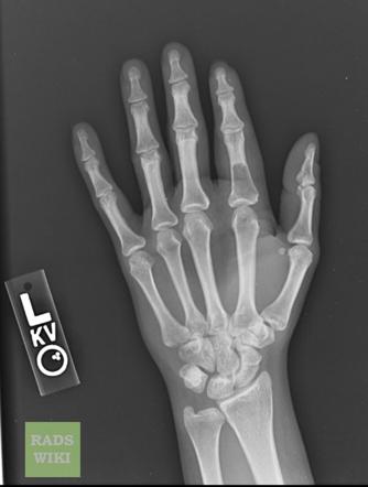 Enchondroma | Radiology Reference Article | Radiopaedia.org