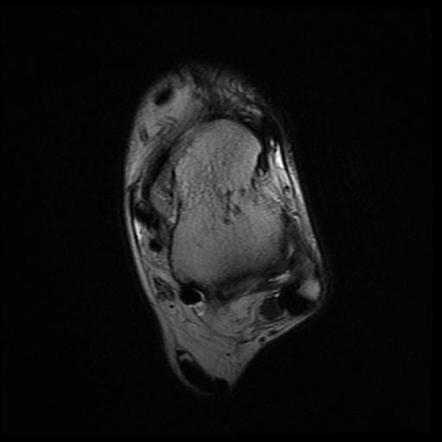 Isolated tear of extensor digitorum longus tendon | Image | Radiopaedia.org