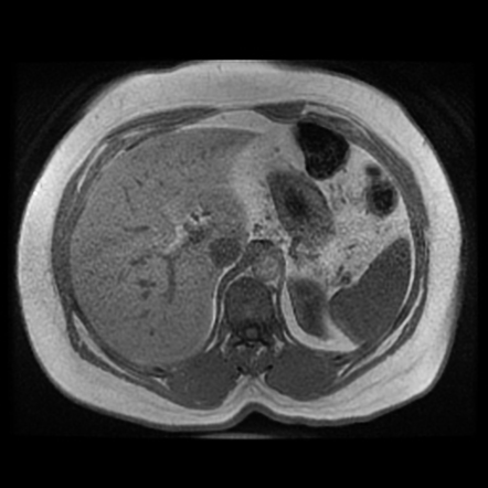 Focal Hepatic Steatosis 