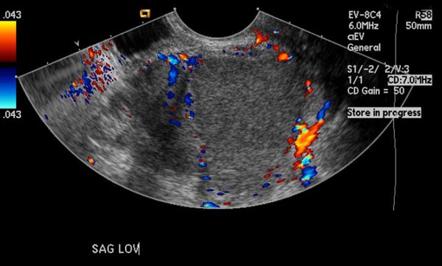 Endometrioma | Radiology Reference Article | Radiopaedia.org