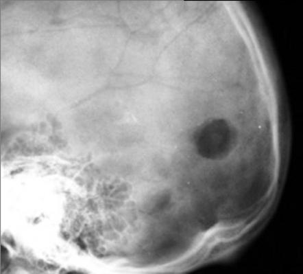 Lytic skull lesion | Radiology Reference Article | Radiopaedia.org